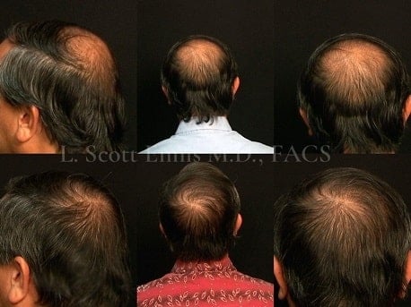 Medical Treatment Options for Male Pattern Hair Loss