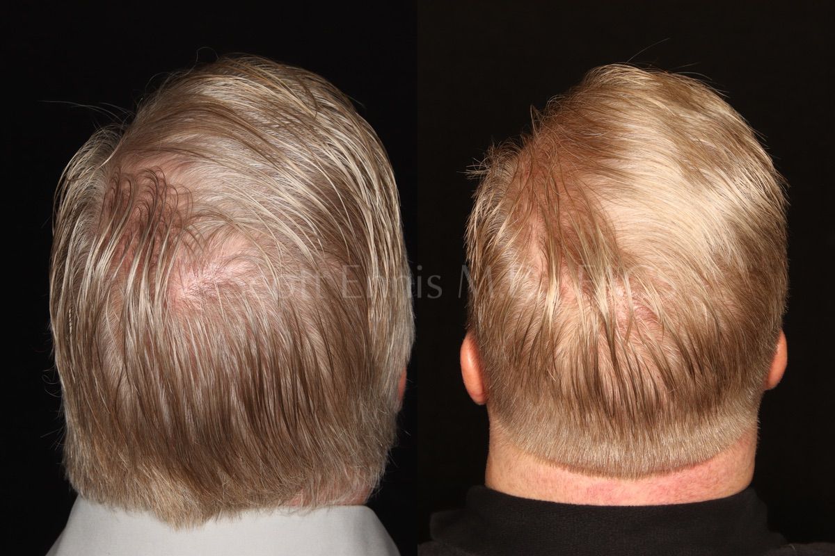 Why choose NeoGraft 2.0 for Hair Restoration and No Scars
