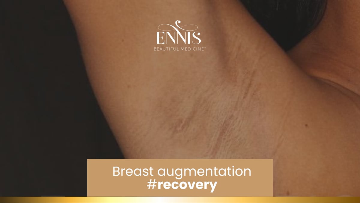 Breast Augmentation Timeline and Tips For Recovery