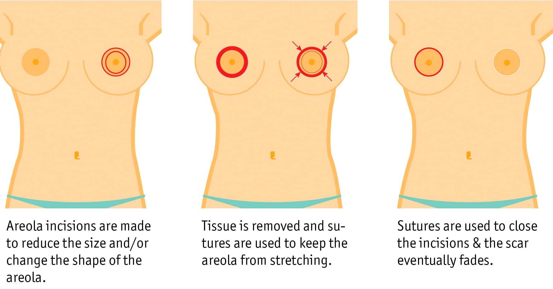Areola reduction surgery illustration showing reduction of enlarged areola diameter