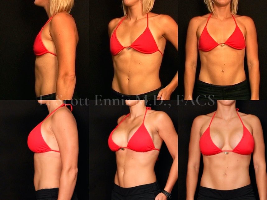 Breast augmentation patient of Dr. Ennis, case 3: before above and after below.