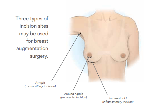 Illustration comparing periareolar, inframammary and transaxillary breast augmentation incisions