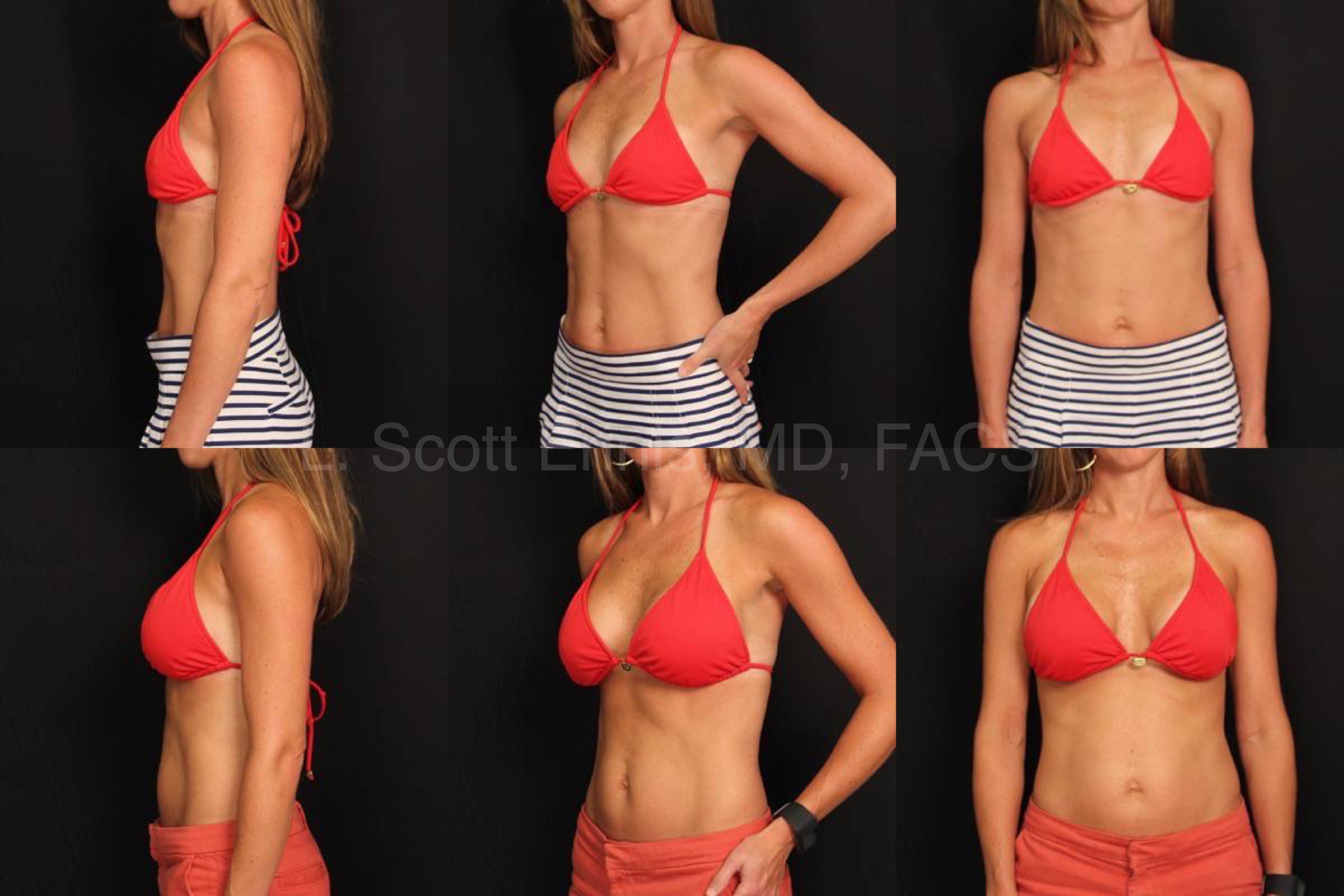 Breast augmentation patient of Dr. Ennis, case 2: before above and after below.