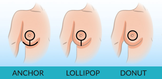 Diagram showing common breast reduction and breast lift incision patterns