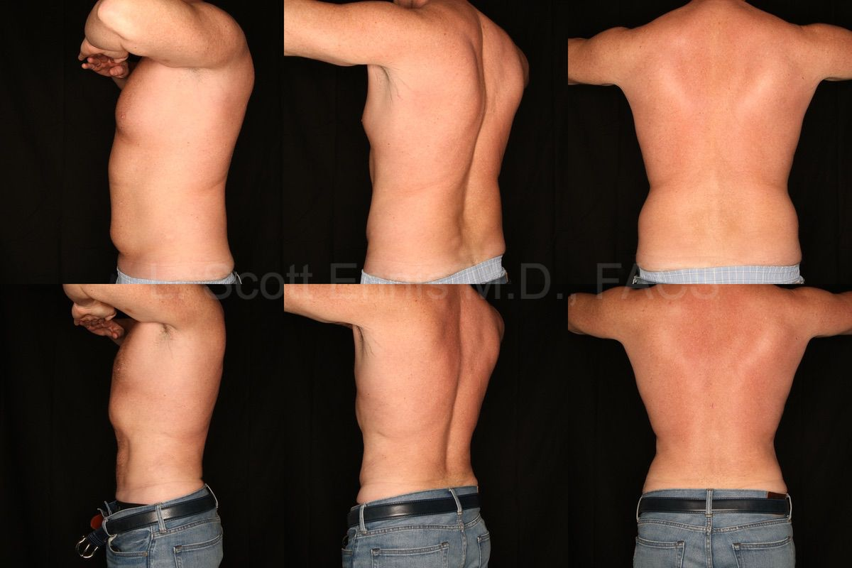 Combined before-and-after body contouring photographs
