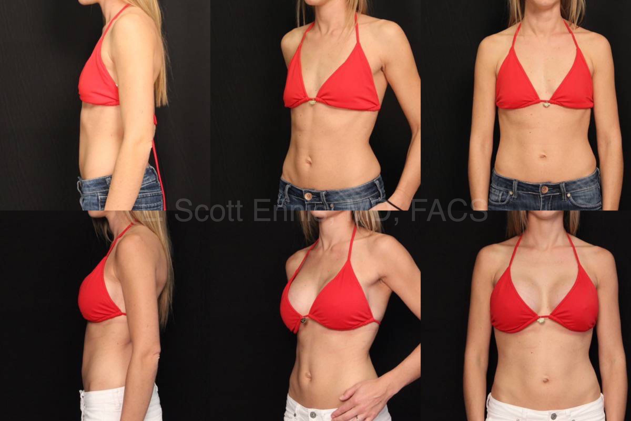 Combined before-and-after breast augmentation photographs, second featured case
