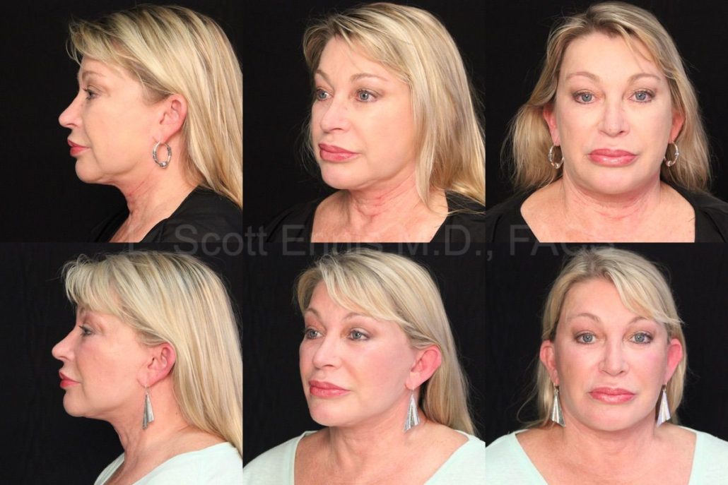 Actual patient of Dr. Ennis: Secondary facelift & buccal fat removal, before above and after below. Case 50479: a combined secondary facelift and buccal fat pad removal.