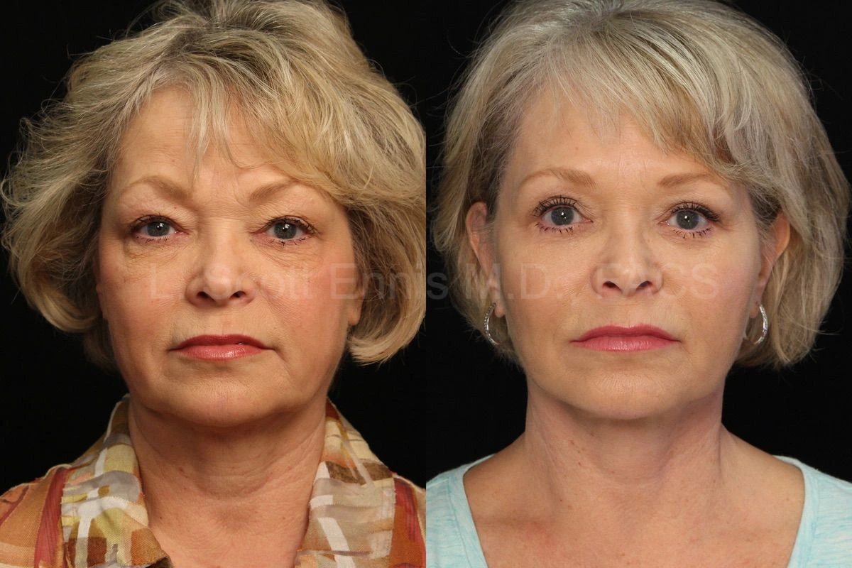 Dr. Ennis patient case 30018: front-view comparison before, left, and after, right, deep plane facelift and lower blepharoplasty.