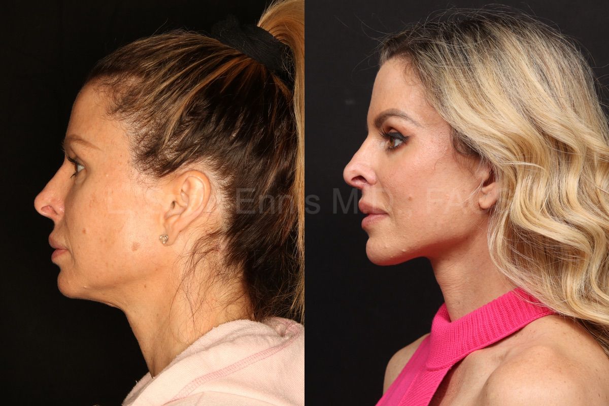 Dr. Ennis patient case 51976: profile comparison before, left, and after, right, deep plane facelift with accompanying facial procedures.