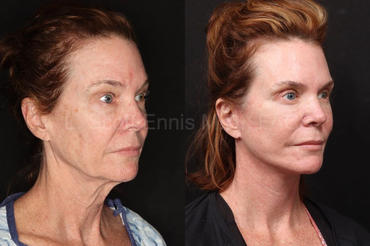 Dr. Ennis patient case 52289: three-quarter-view comparison before, left, and after, right, deep plane facelift with accompanying facial procedures.