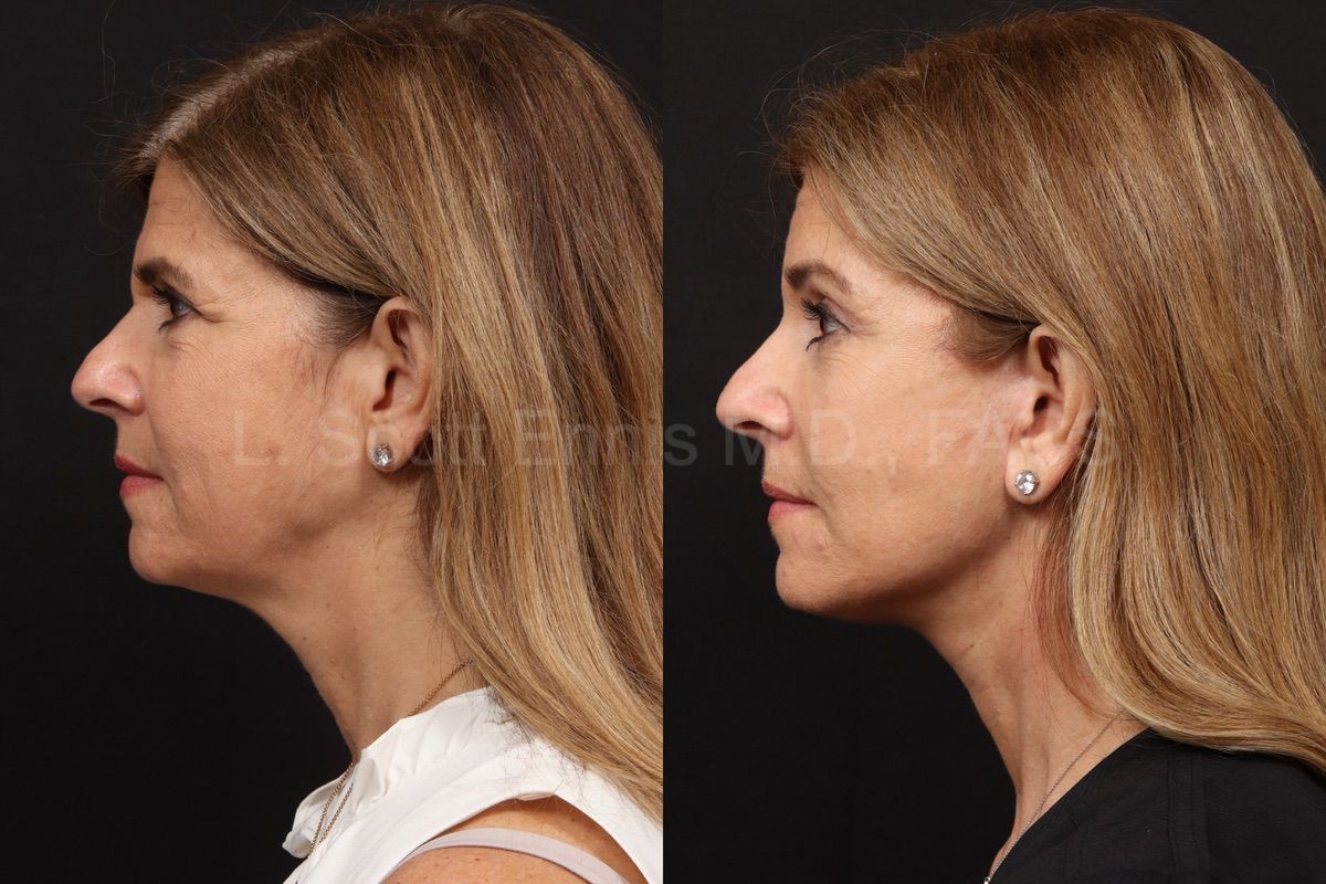 Dr. Ennis patient case 53006: profile comparison before, left, and after, right, deep plane facelift with accompanying facial procedures.