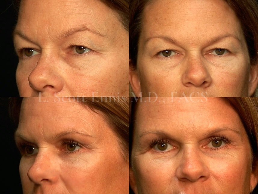 Dr. Ennis patient case 274dada: two views before, top row, and after, bottom row, upper and lower blepharoplasty.