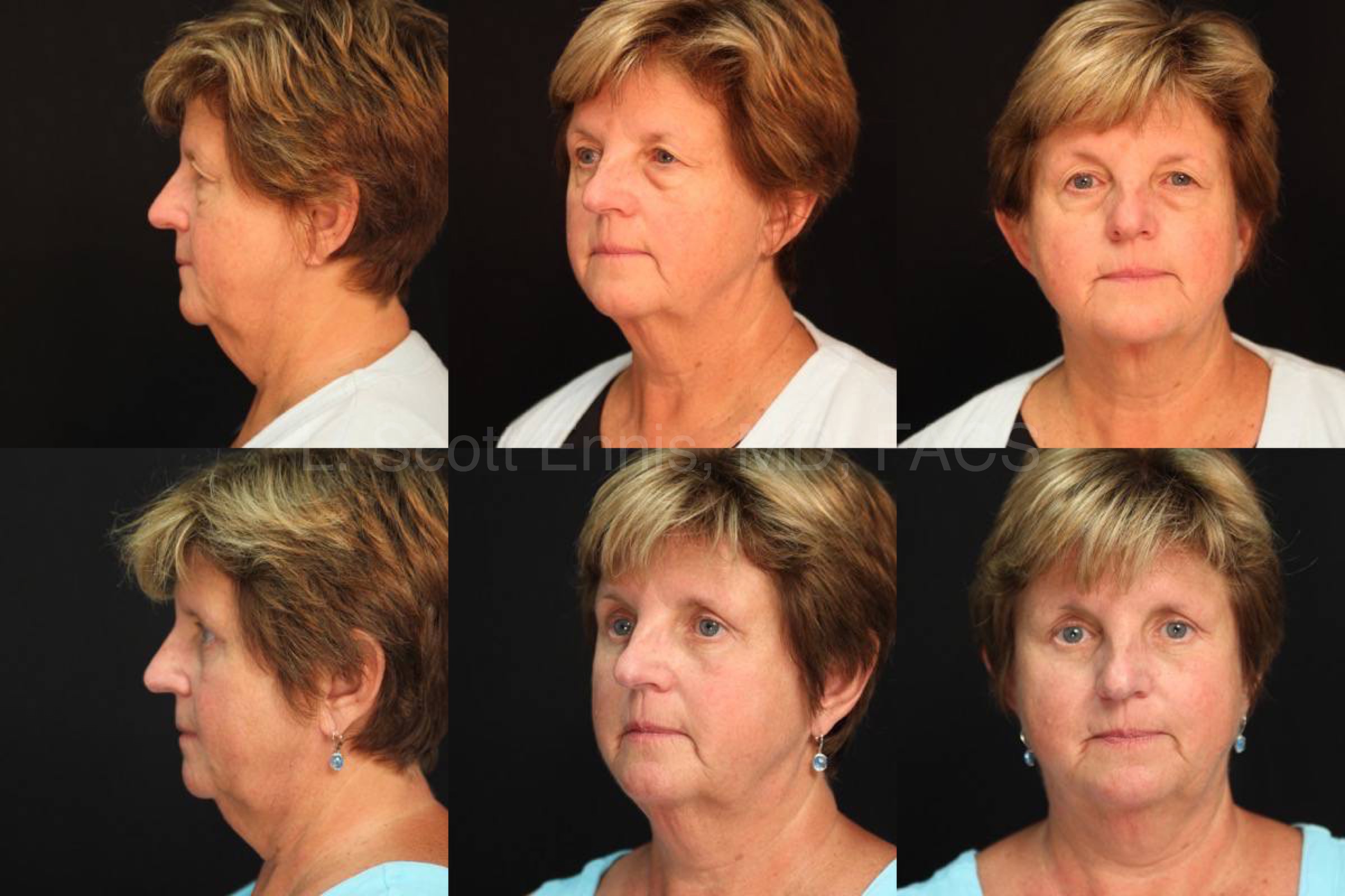Dr. Ennis patient case 37249: three views before, top row, and after, bottom row, bilateral upper and lower blepharoplasty.