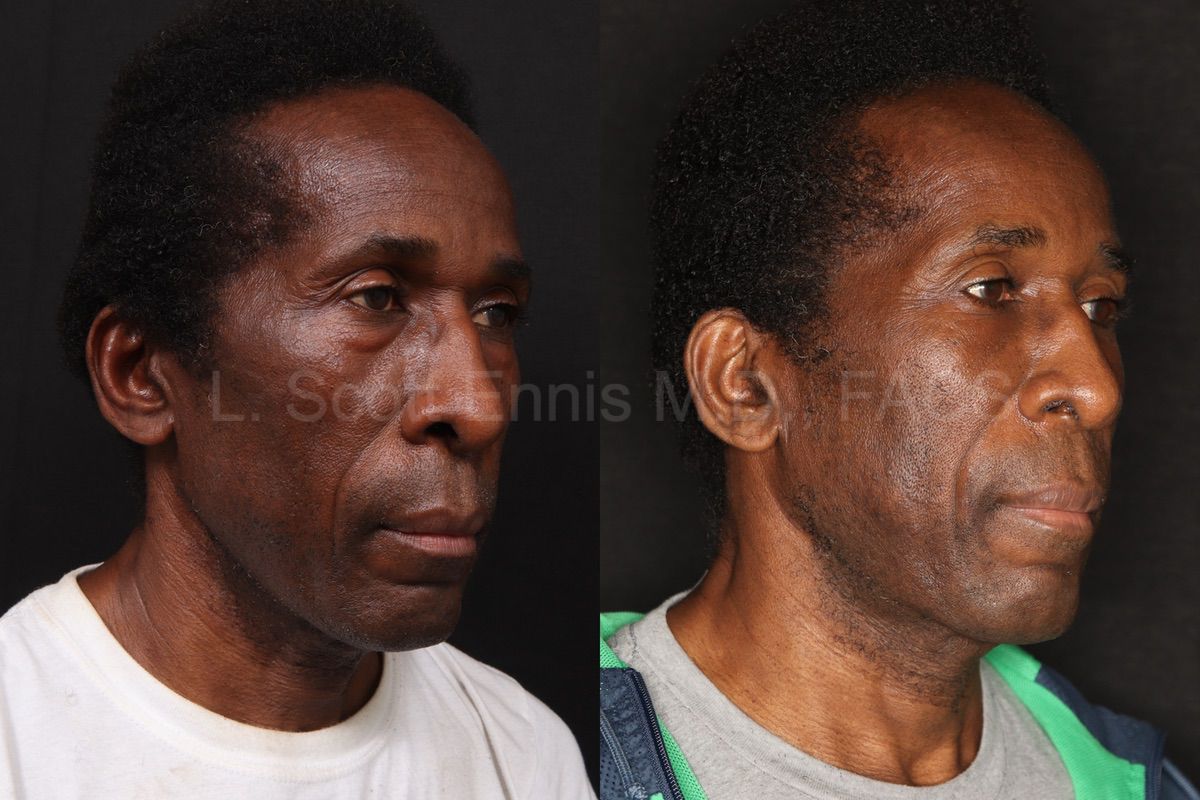 Dr. Ennis patient case 52538: three-quarter views before, left, and after, right, lower blepharoplasty.