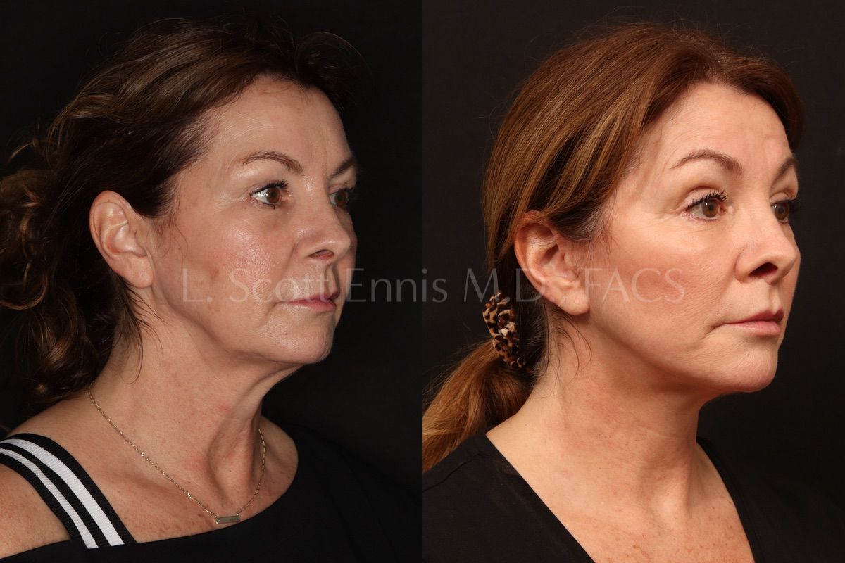 Combined before-and-after facelift photographs, case 53626