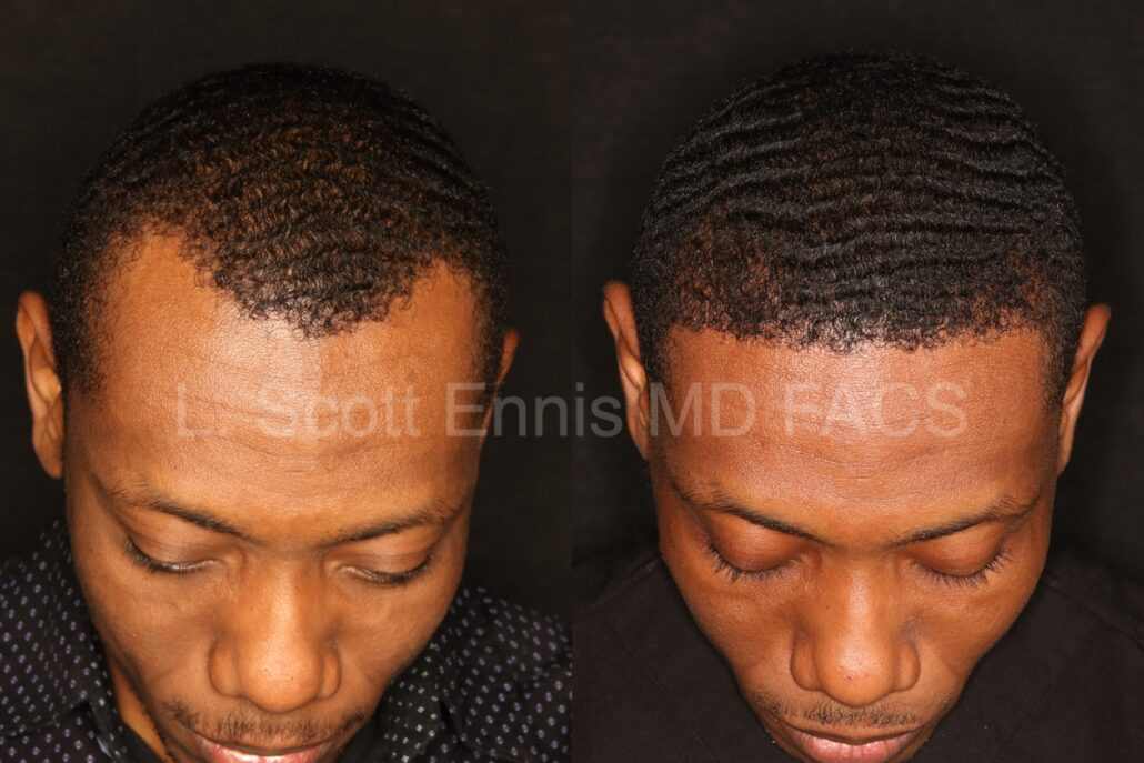 Combined before-and-after hair restoration photographs, first featured case