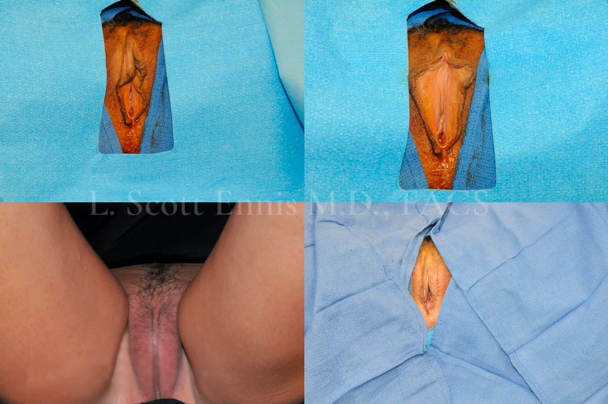 Clinical labiaplasty before-and-after comparison by Dr. Ennis, case 2; labels are part of the original image.