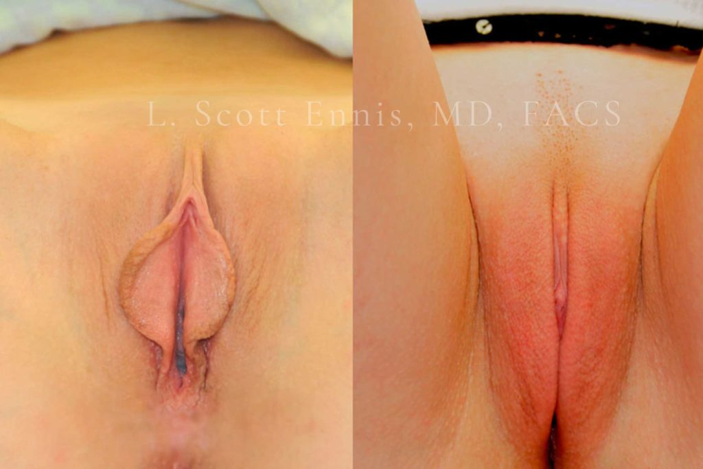 Clinical labiaplasty before-and-after comparison by Dr. Ennis, case 1; labels are part of the original image.