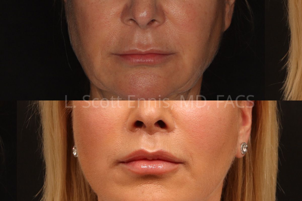 Actual patient of Dr. Ennis: Upper lip lift, before above and after below. Close-up comparison from the practice’s published lip lift series.
