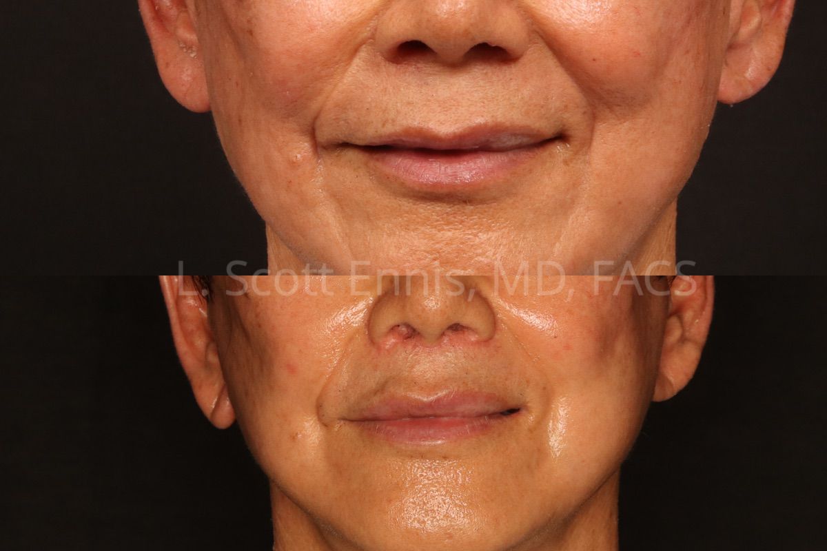Actual patient of Dr. Ennis: Upper lip lift, before above and after below. A second close-up comparison from the published lip lift series.