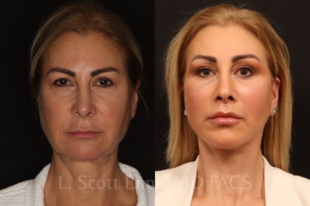 Actual patient of Dr. Ennis: Lip lift & facial rejuvenation, before left and after right. Combined with endoscopic brow lift, lower blepharoplasty, deep plane facelift and buccal fat removal.