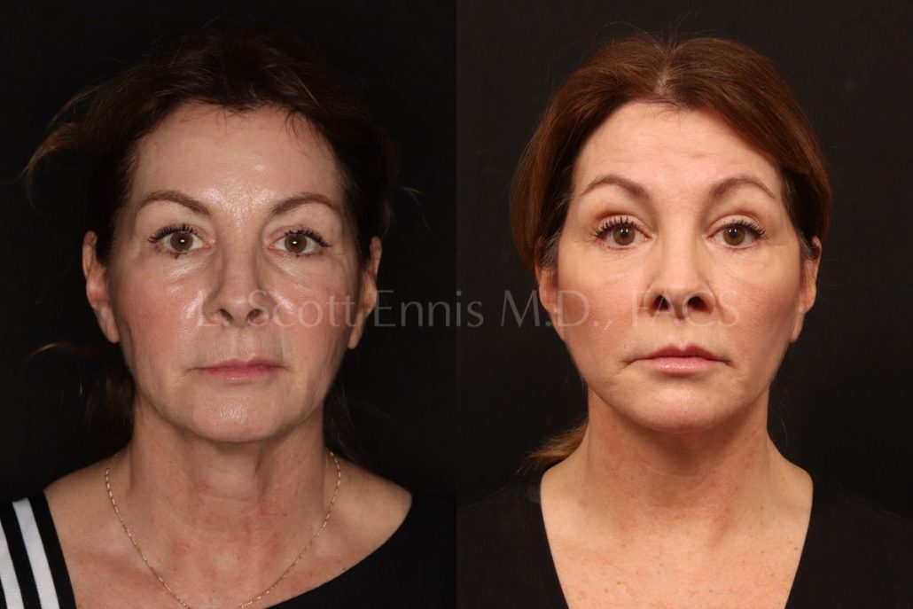 Actual patient of Dr. Ennis: Lip lift & facelift, before left and after right. Case 53626: combined with facelift and buccal fat pad removal.
