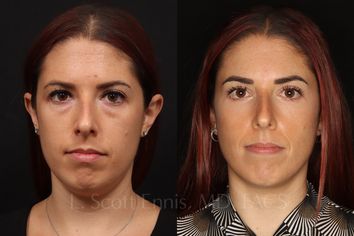 Dr. Ennis patient case 53763: front views before, left, and after, right, lower blepharoplasty.