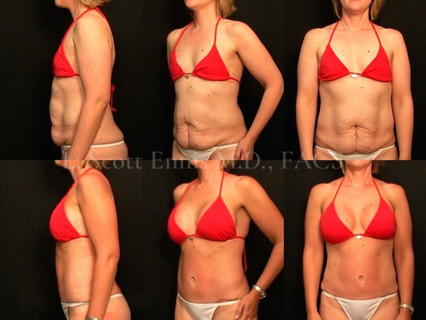 Combined before-and-after mommy makeover photographs