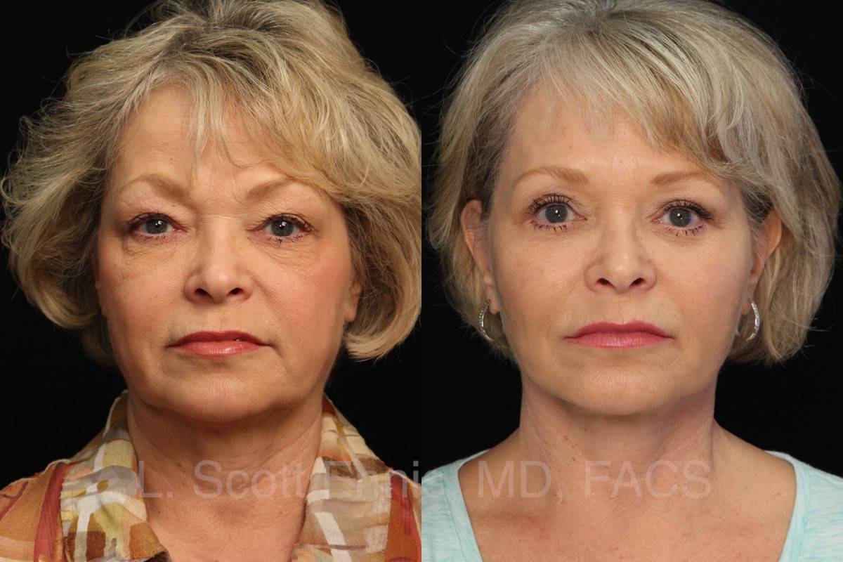 Dr. Ennis patient case 15969: front views before, left, and after, right, facelift, neck lift, lower blepharoplasty and Obagi Blue Peel.