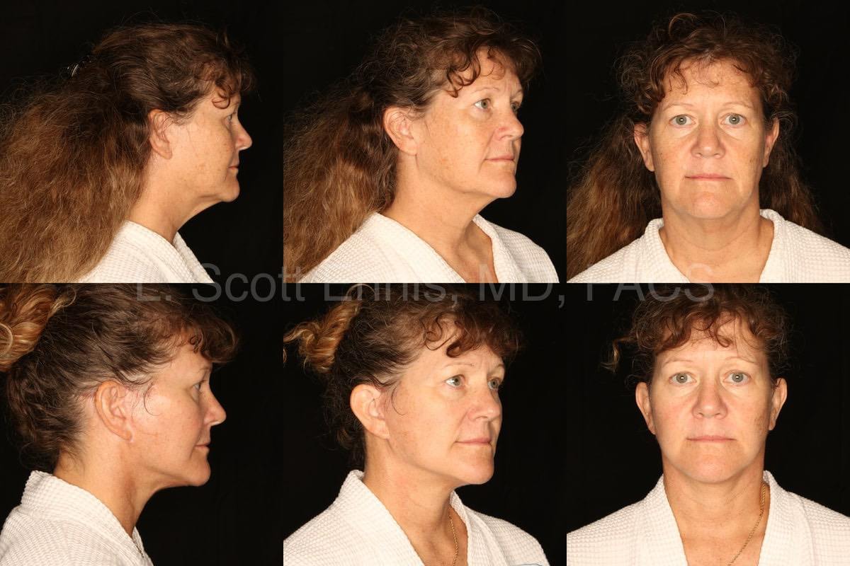 Dr. Ennis patient case 16845: three views before, top row, and after, bottom row, mini facelift.