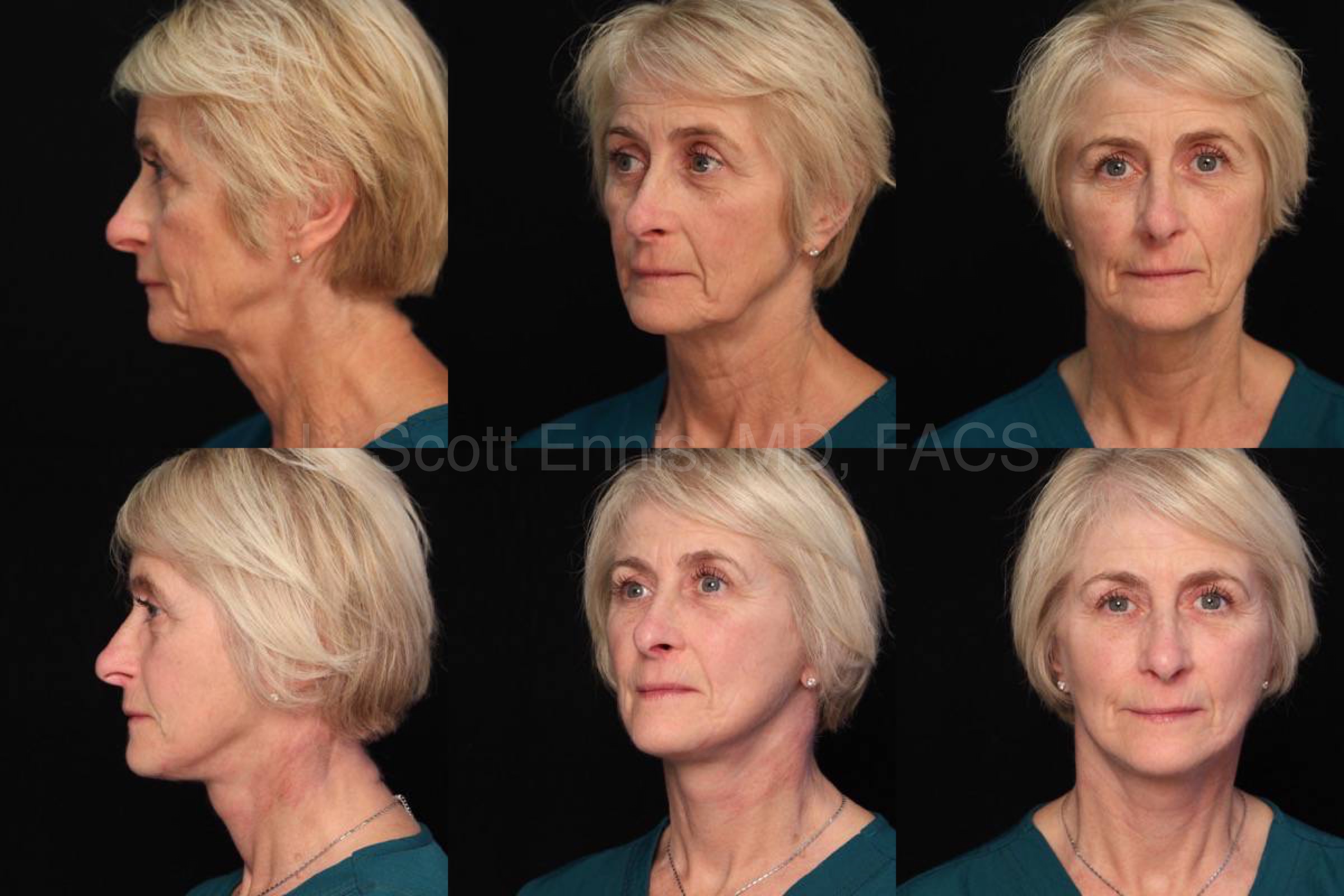Dr. Ennis patient case 38015: three views before, top row, and after, bottom row, SMAS facelift and Obagi Blue Peel.