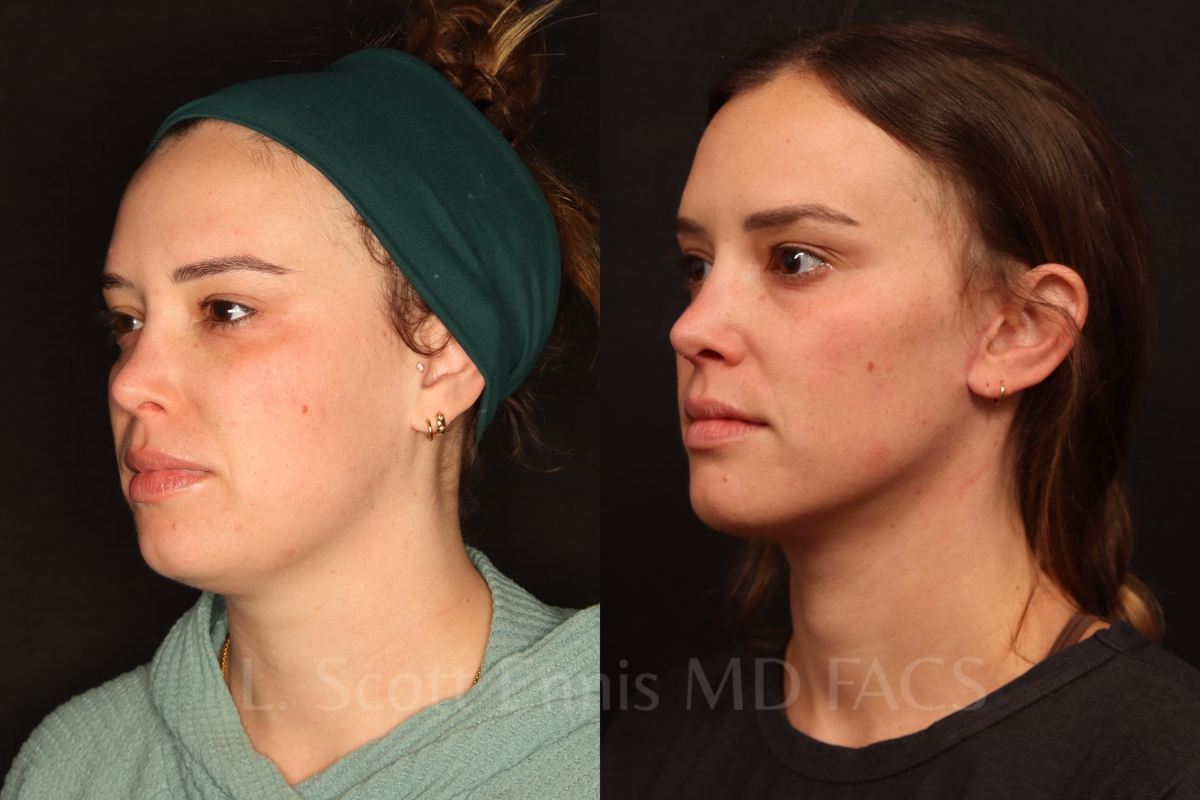 Dr. Ennis patient case 58619: three-quarter views before, left, and after, right, neck liposuction with a mini facelift.