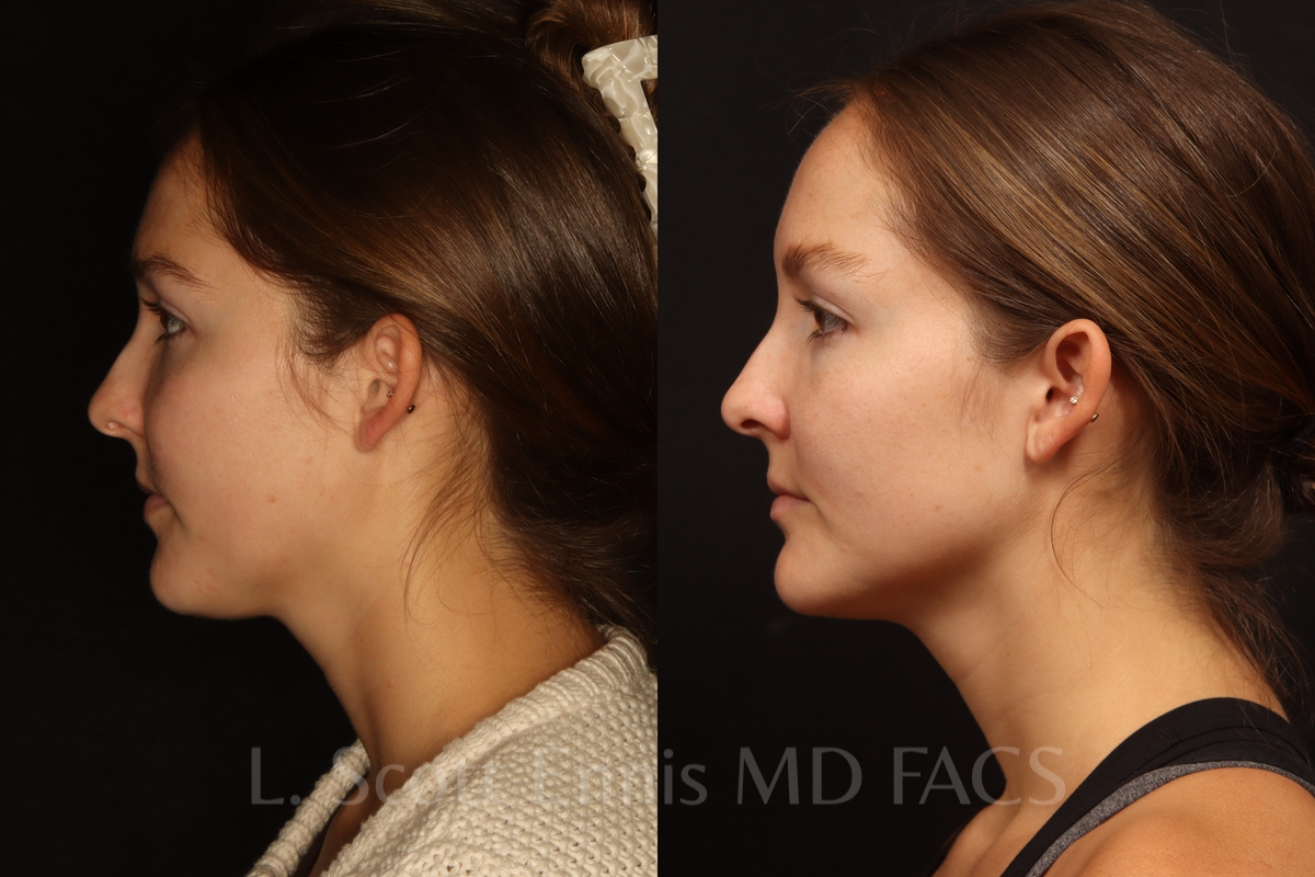 Actual patient of Dr. Ennis: Neck liposuction, before left and after right. Case 55703: profile comparison.
