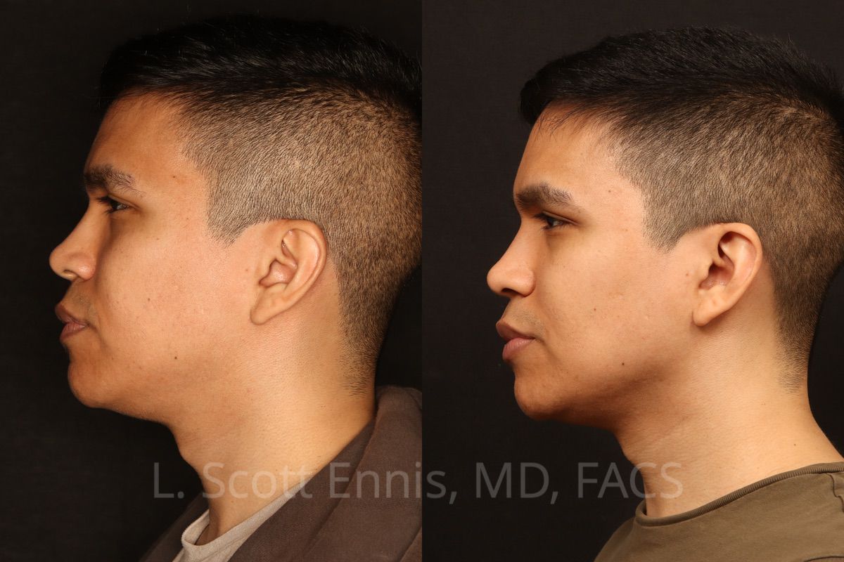 Actual patient of Dr. Ennis: Neck liposuction & buccal fat removal, before left and after right. Case 57221: combined neck and cheek treatment.