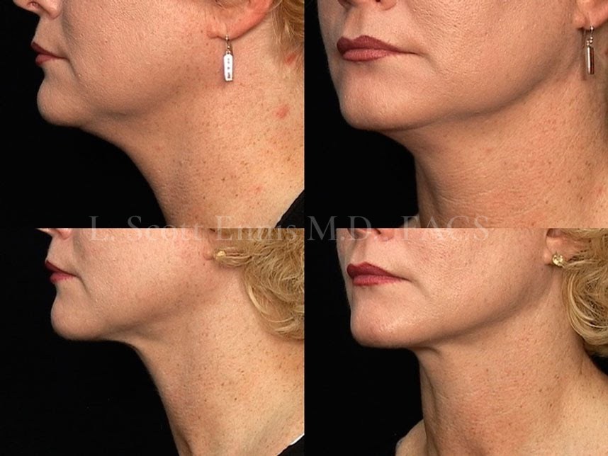 Actual patient of Dr. Ennis: Neck liposuction, before left and after right. Two views of one patient from the published procedure page.