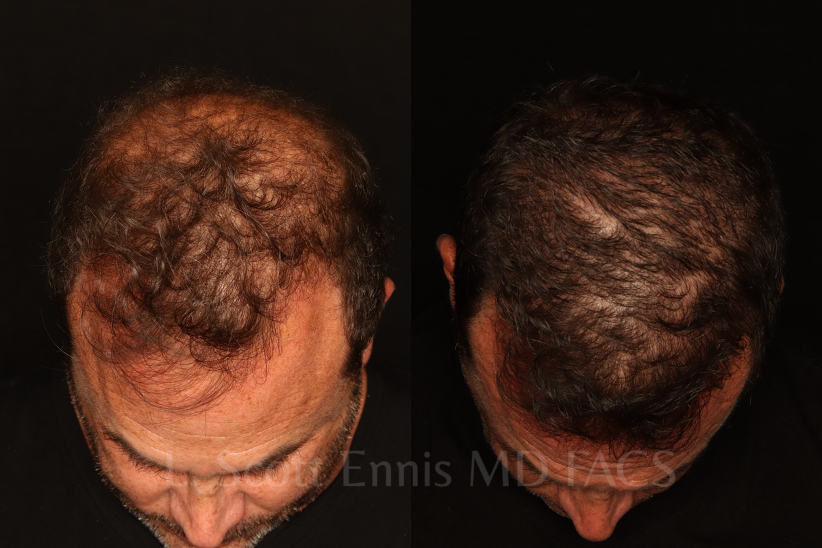 Hair restoration comparison. Before left; after right.