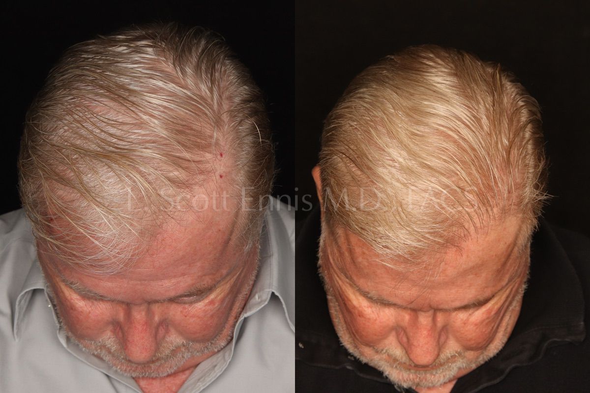 Hair-restoration comparison by Dr. Ennis. Before left · After right. Original clinical photos and watermark preserved.