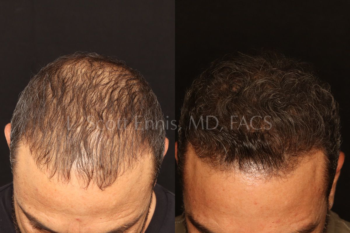 Hair restoration comparison. Before left; after right.