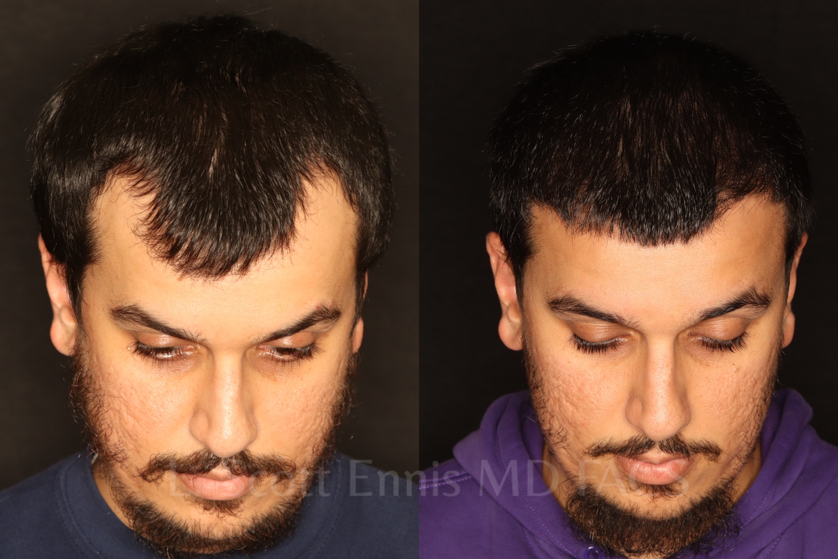 Hair restoration comparison. Before left; after right.