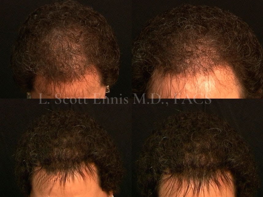 Hair-restoration comparison by Dr. Ennis. Before above · After below. Original clinical photos and watermark preserved.