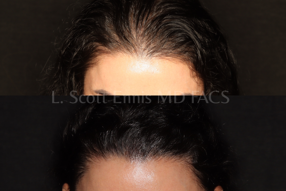 Hair restoration comparison. Before above; after below.