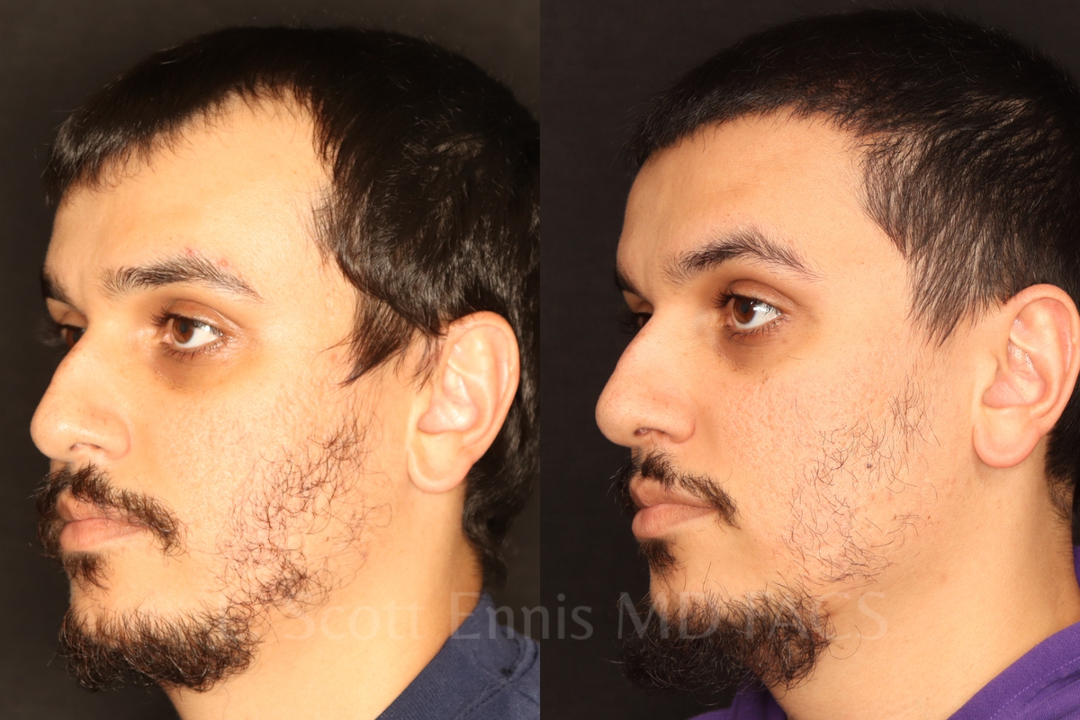 Hair restoration comparison. Before left; after right.