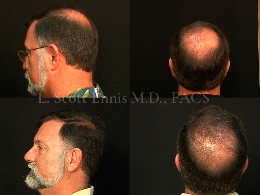 Hair-restoration comparison by Dr. Ennis. Before above · After below. Original clinical photos and watermark preserved.