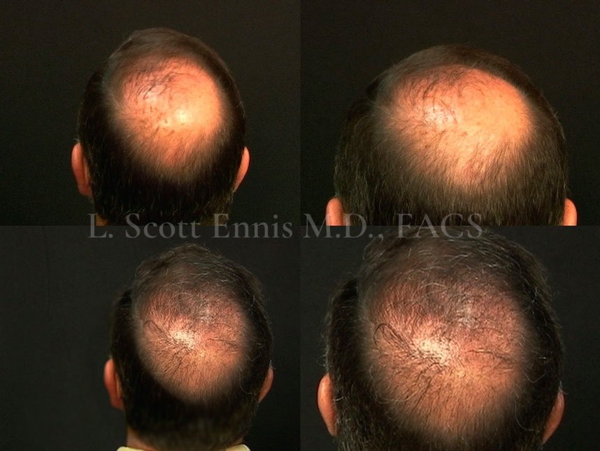 Hair-restoration comparison by Dr. Ennis. Before above · After below. Original clinical photos and watermark preserved.