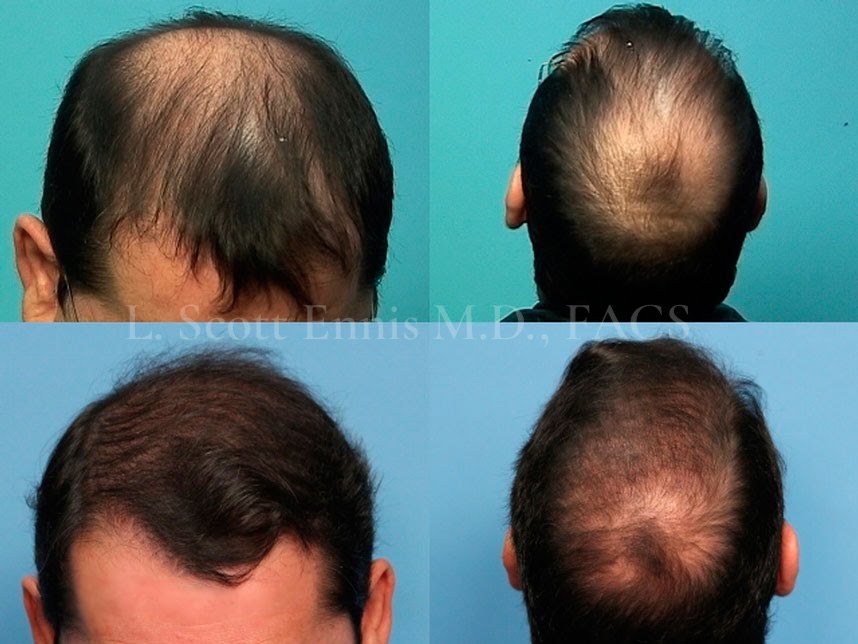 Hair-restoration comparison by Dr. Ennis. Before above · After below. Original clinical photos and watermark preserved.