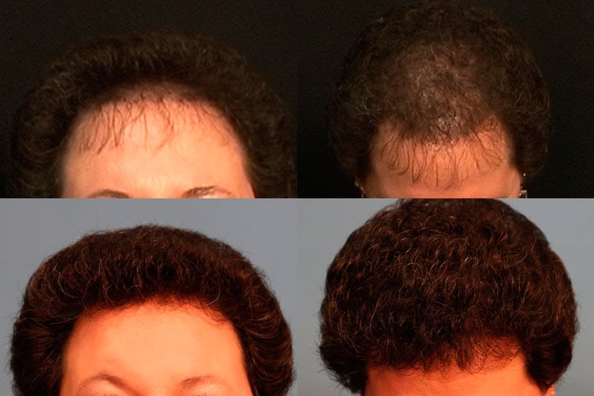 Hair-restoration comparison by Dr. Ennis. Before above · After below. Original clinical photos and watermark preserved.