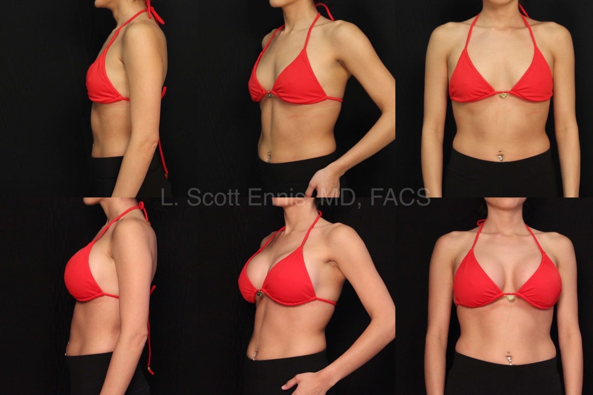 Breast Implant Sizes — accompanying illustration or photograph
