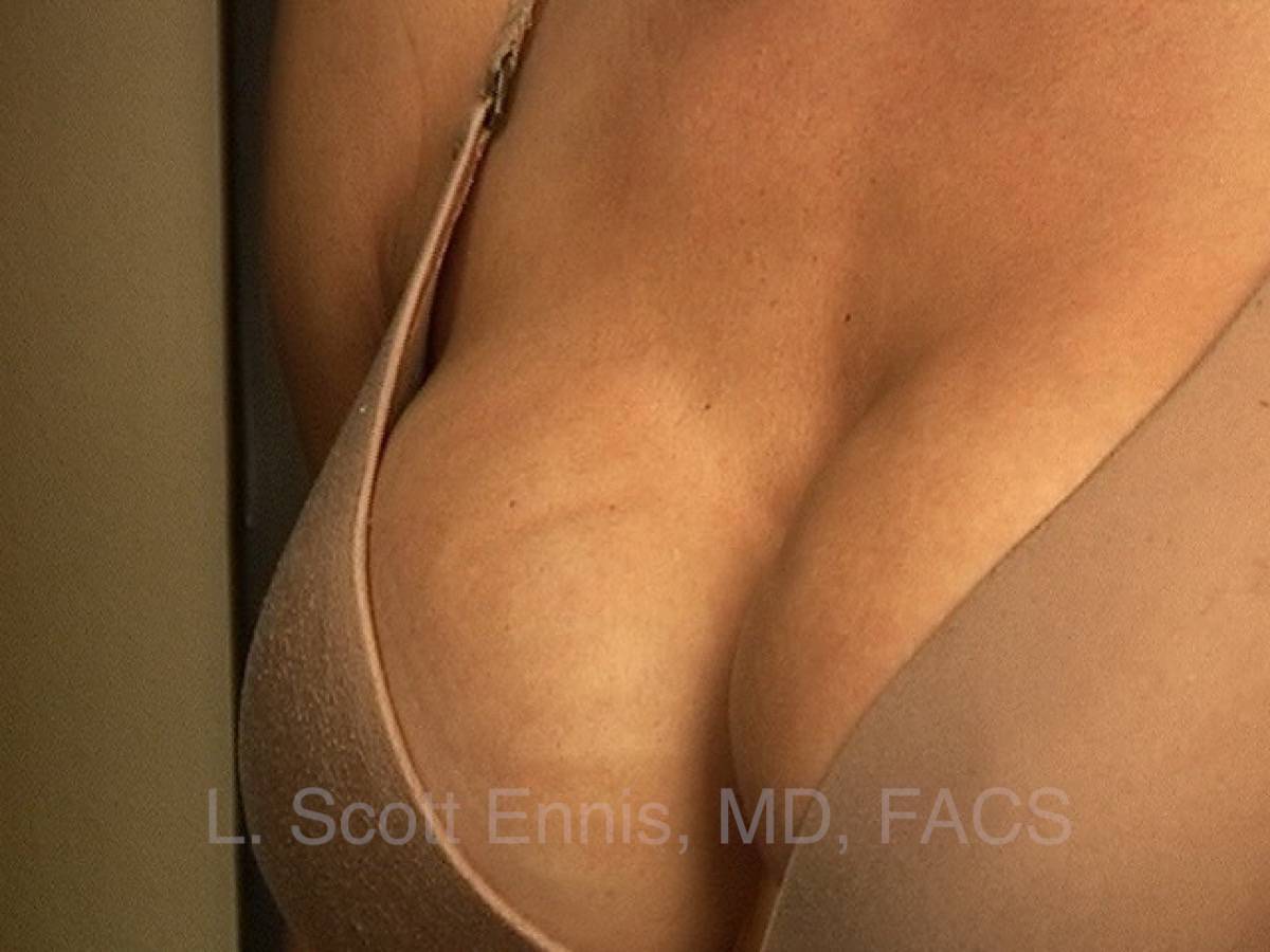 Breast Implant Rippling — accompanying illustration or photograph
