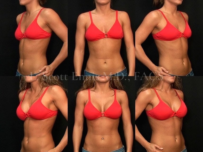 Introducing Natrelle Inspira Soft Touch Implants — accompanying illustration or photograph