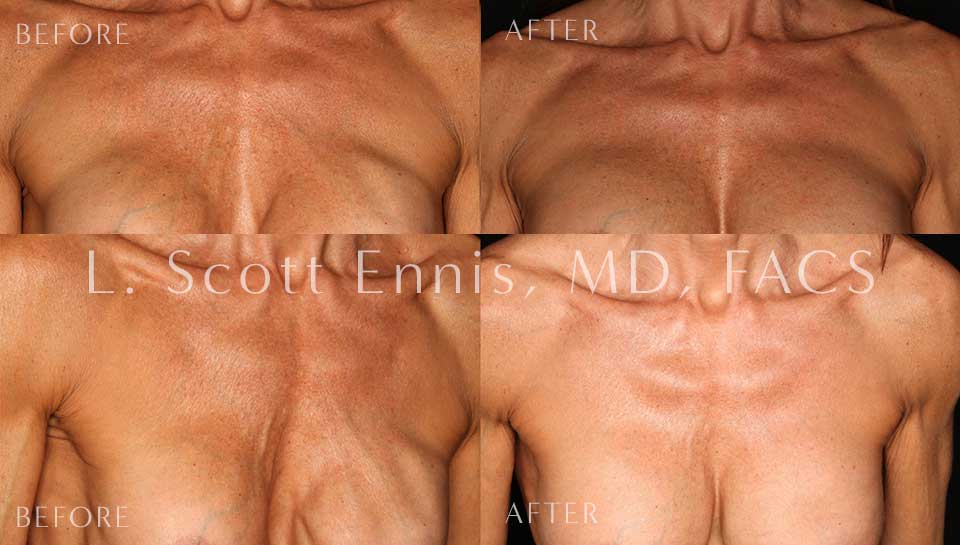 Breast Implant Rippling — accompanying illustration or photograph